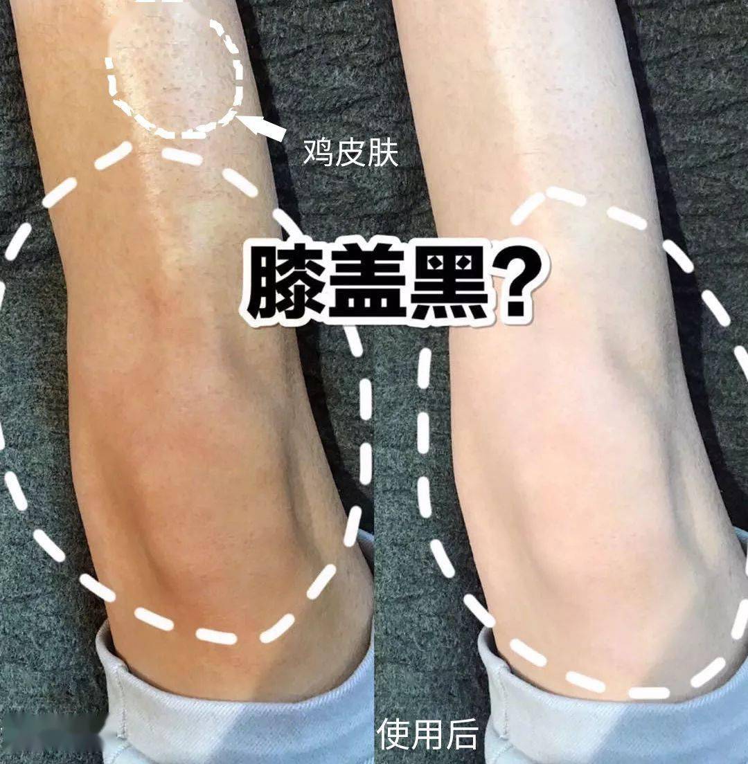 鸡皮肤腋下黑是怎么回事(鸡皮肤腋下黑是怎么回事儿)