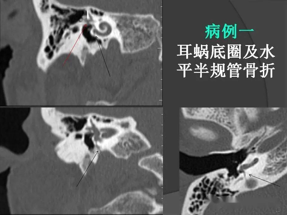 颞骨断层解剖及ct三维重建