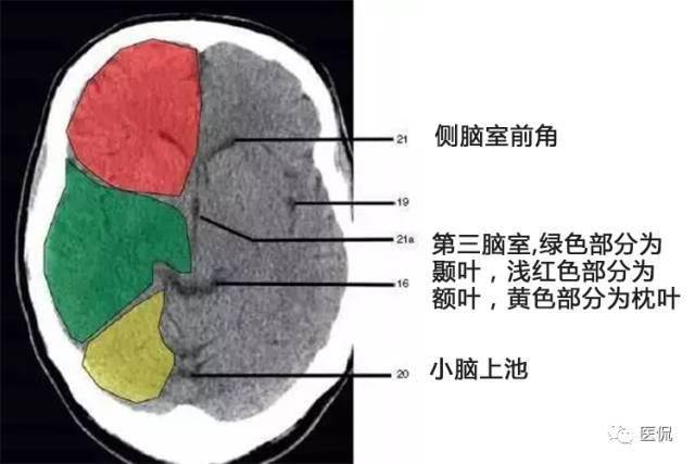 顱腦ct解剖口訣及彩色解剖圖