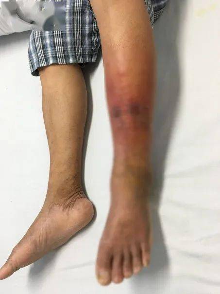 感染引起的一种急性感染性皮肤疾病,最常见的感染部位是下肢和面部