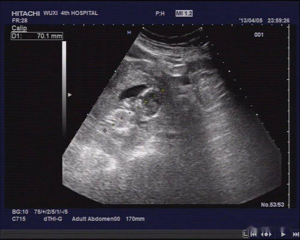 超声典型病例 :阔韧带妊娠