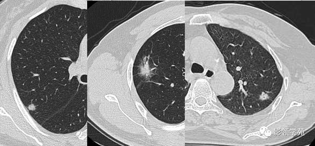 肺泡癌影像诊断与鉴别诊断