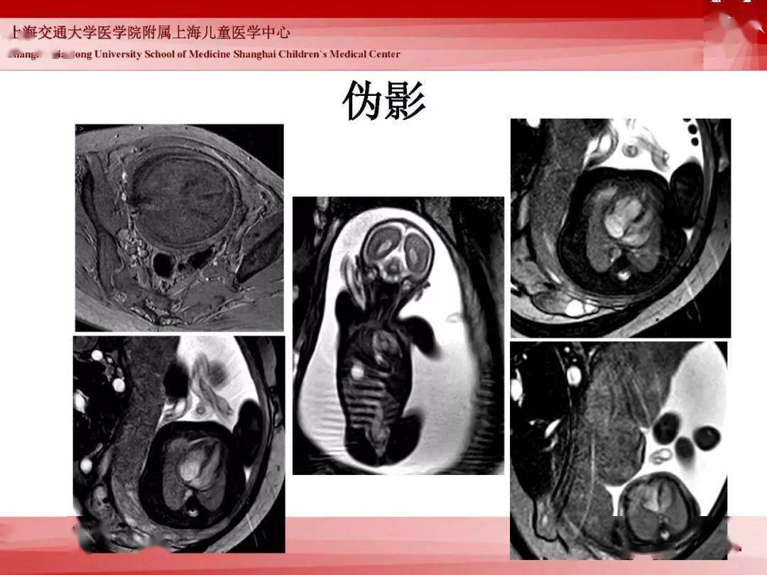 胎兒磁共振的檢查技術