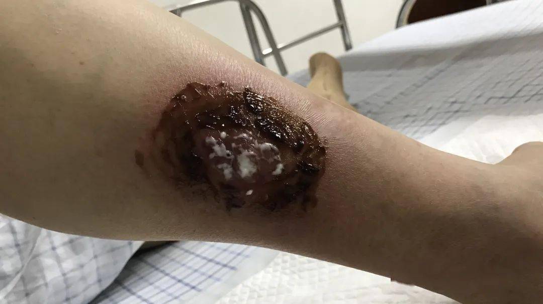 医生说,严重时会发生"败血症"……_皮肤