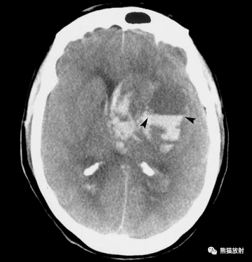 脑实质内出血的演变,分布,ct表现