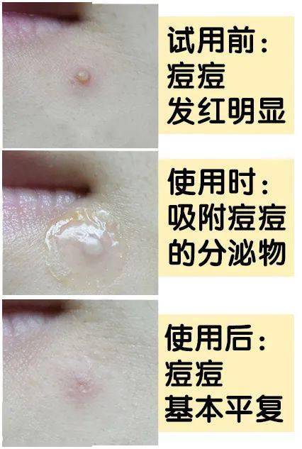 "拔"出黄脓,快速消痘!让肌肤变成"白煮蛋",就是这么简单!