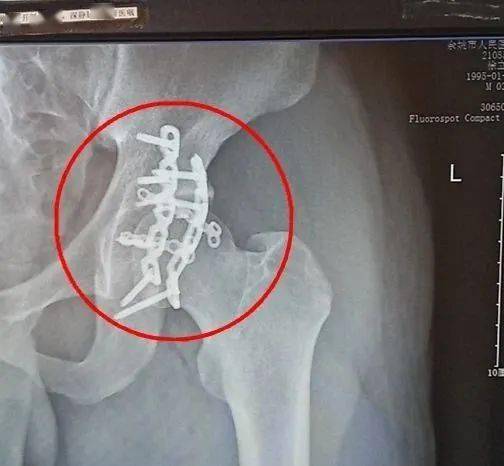 意外车祸小伙全身多处粉碎性骨折细心医生用微创技术解除后顾之忧