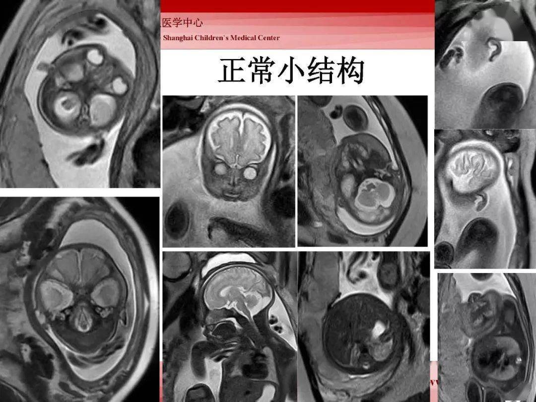 胎儿磁共振的检查技术