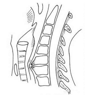 食管压迫型颈椎病图片图片