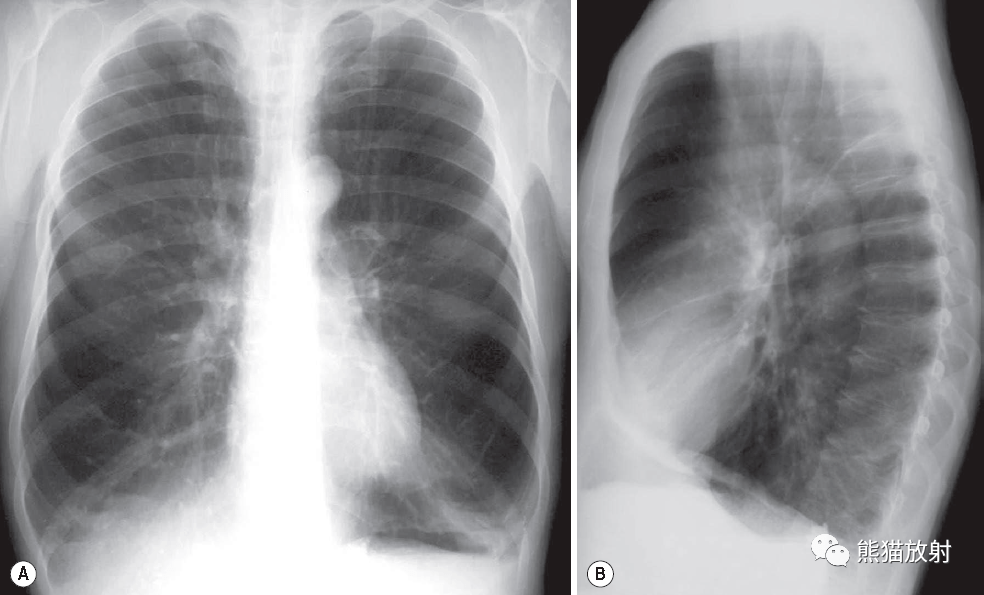慢性支气管炎X线图片