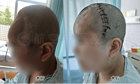 重庆小夫妻遇车祸演绎坚贞爱情,北京大专家修颅骨重塑完美容颜