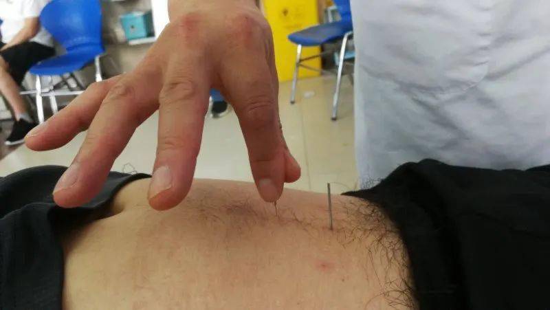 针刺治疗中风后尿潴留优势病例分析