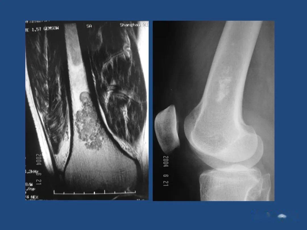 5种骨关节恶性肿瘤mri诊断及鉴别