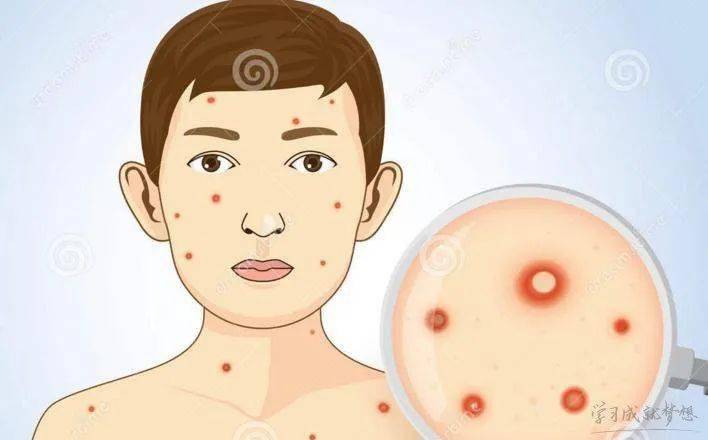 水痘是由带状疱疹病毒感染引起的,婴幼儿常见的急性呼吸道传染病,常