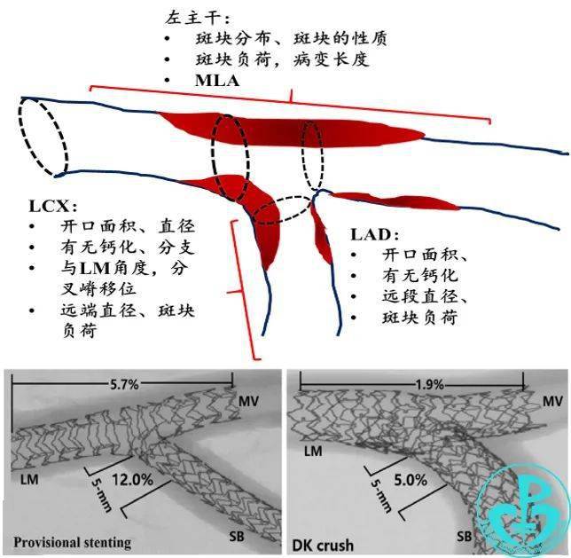 cici大会oct参赛病例oct指导dkcrush术式治疗左主干分叉病变