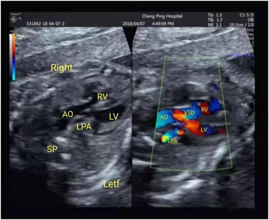 超声典型病例胎儿法洛四联症合并右位主动脉弓