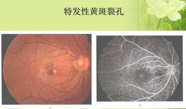 眼底病黄斑裂孔