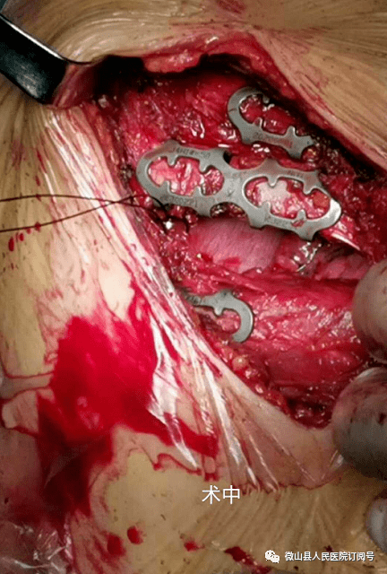 我院胸外科团队自2014年开展肋骨骨折内固定手术以来,以及为200余名