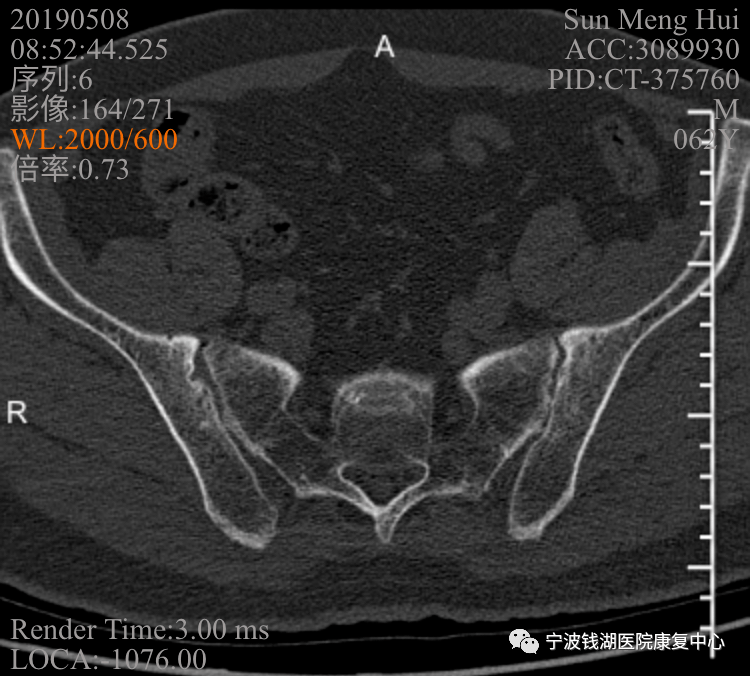 2019-05-8:骶髂关节ct:双侧骶髂关节炎,请结合临床.