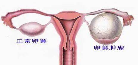 儿童期卵巢肿瘤相对少见,大的卵巢肿瘤更是少见.