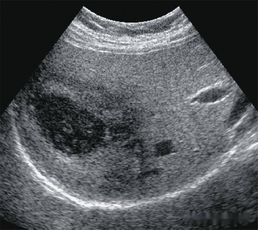 【超声随响】第05期 肝细胞腺瘤 hepatic adenoma