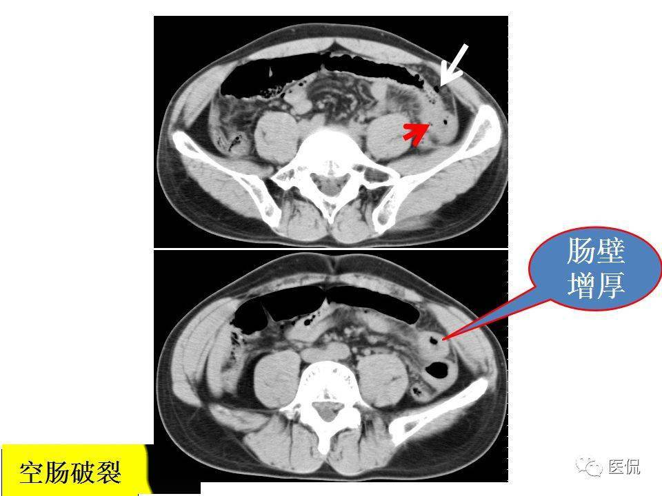 放射科急诊必看肠管与肠系膜损伤ct诊断