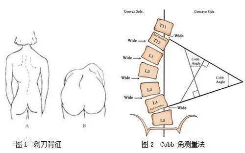 人手一冊脊柱骨折和脊柱側彎患者出院指導手冊