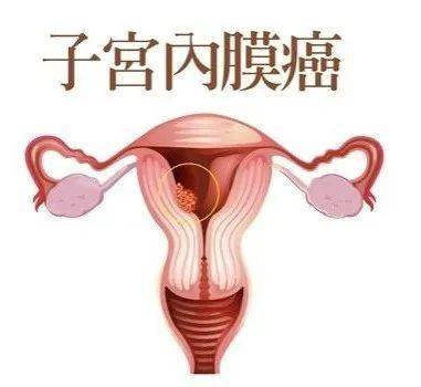 乳房湿疹样癌早期表现_宫颈早期浸润癌存活率_早期宫颈癌的哪8种症状表现