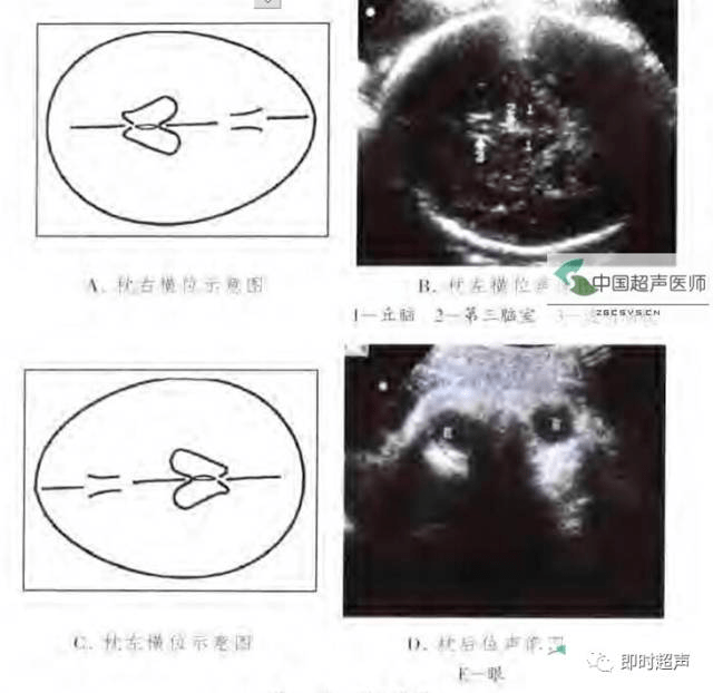 产科实用技能:如何通过超声辨别胎方位?附多图讲解!_母体