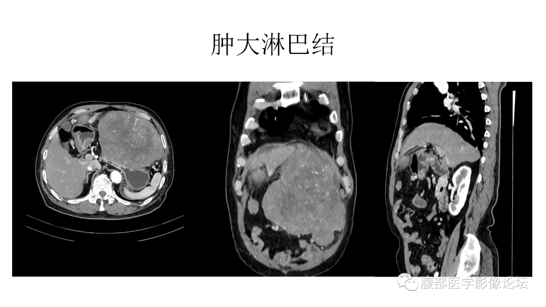 半年內腫塊倍增太快,考慮惡性:常規考慮惡性間質瘤並多發種植轉移