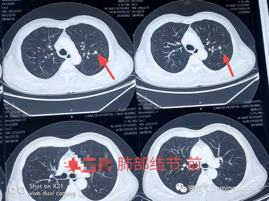 双肺多发小结节 来自搜狐网