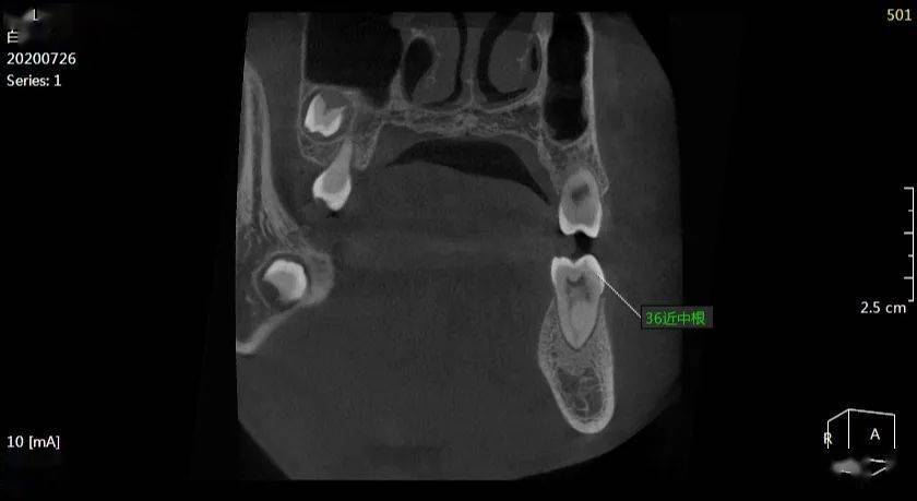 白xx 20200726 囊腫cbct 138xxxx5266