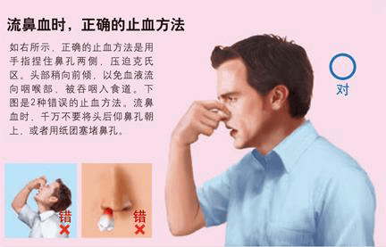 流鼻血时该仰头止血还是捏鼻止血