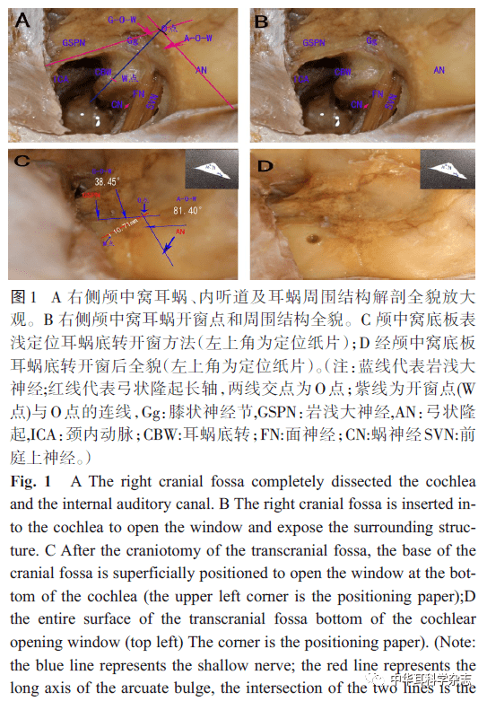 經顱中窩人工耳蝸植入開窗點定位的解剖學研究