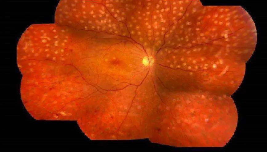 眼睛里面出血可以光吃药不手术吗?