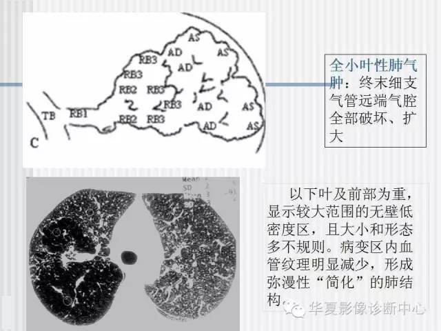 天天说的肺气肿分型是怎么分的呢