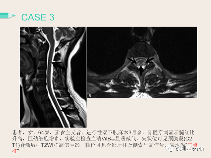 脊髓亚急性联合变性影像表现