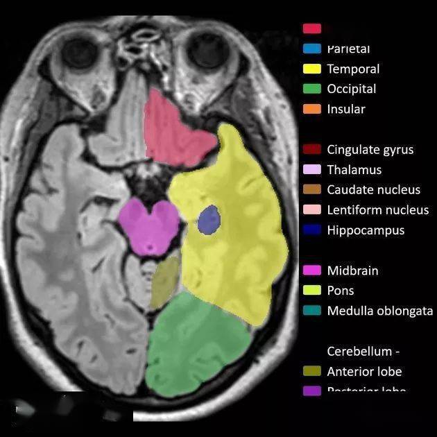 解剖丨腦葉分佈mri圖像彩色標註