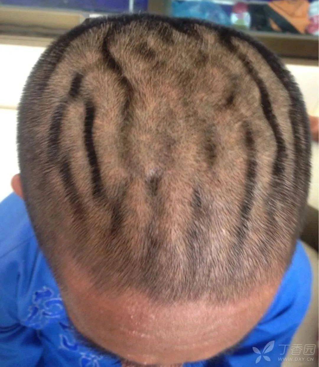 简要病史:头皮异常合并杵状指 5 年.
