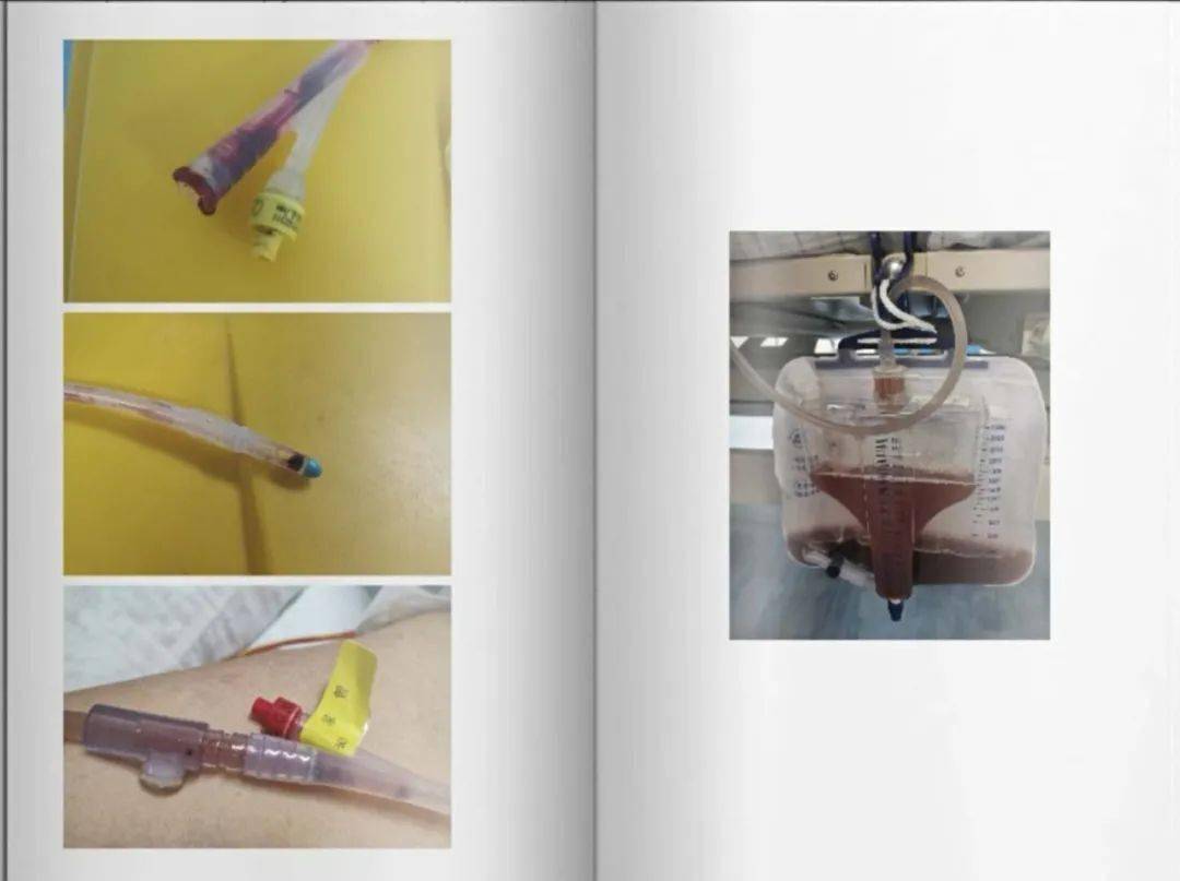 尿管堵住缘何起一例肾脏切除术后尿管堵塞的案例分享