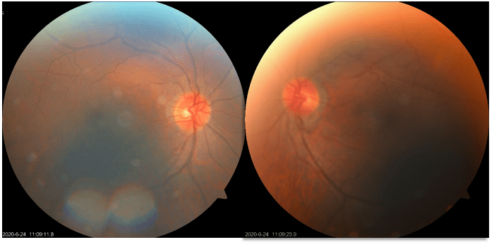 每周最佳病例分享视神经炎