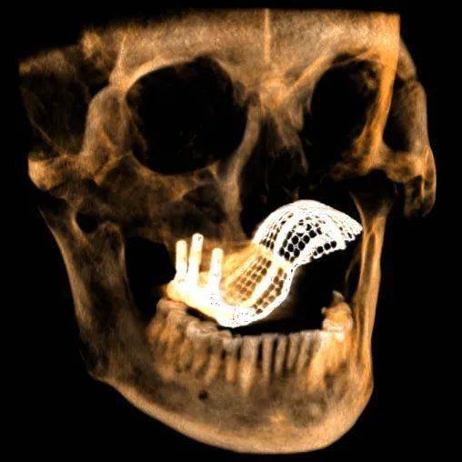 口腔科门诊完成一例单侧颌骨完全缺失复杂种植修复病例