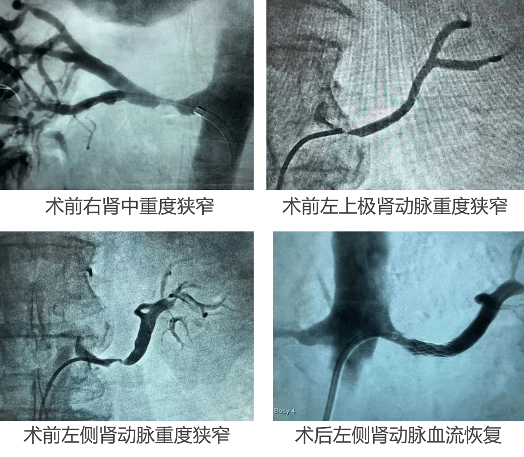 经典病例| 顽固性高血压病史30余年,肾动脉支架植入术有效缓解