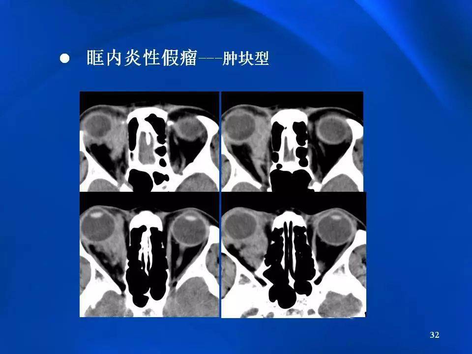 眶内炎性假瘤影像学表现