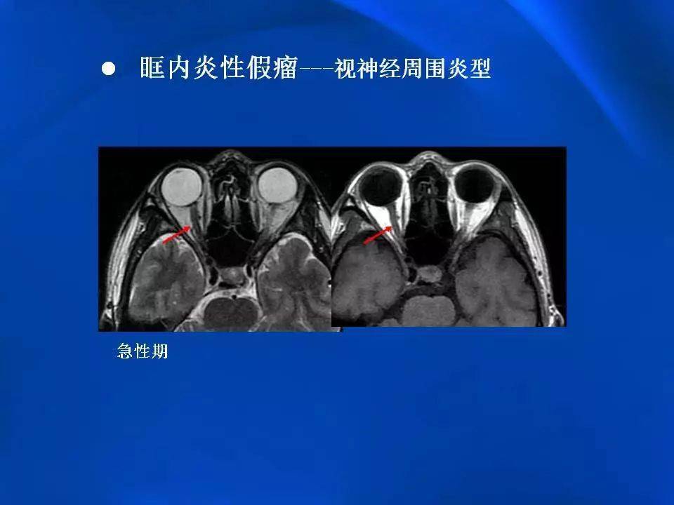 眶内炎性假瘤影像学表现