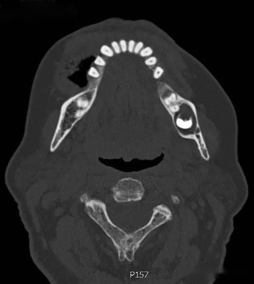 含牙囊肿影像诊断