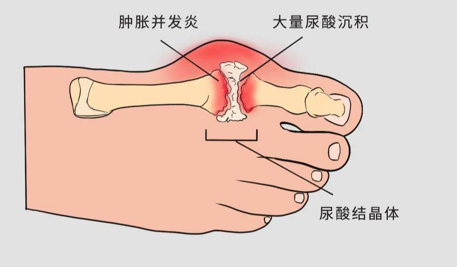 【惠仁堂痛风日】如何让体内尿酸盐结晶溶解排出?