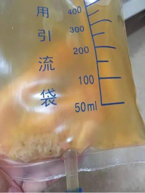 腹腔引流管健康宣教我们该和患者聊点什么