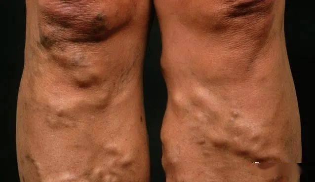 小腿静脉曲张是因为下肢血管堵塞严重引起动脉硬化而导致的,小腿静脉