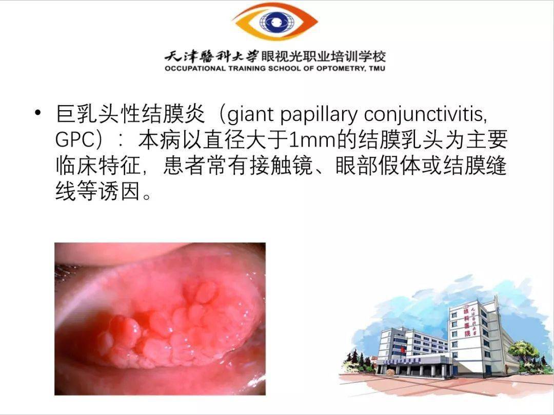 【眼视光】 过敏性结膜炎-搜狐大视野-搜狐新闻